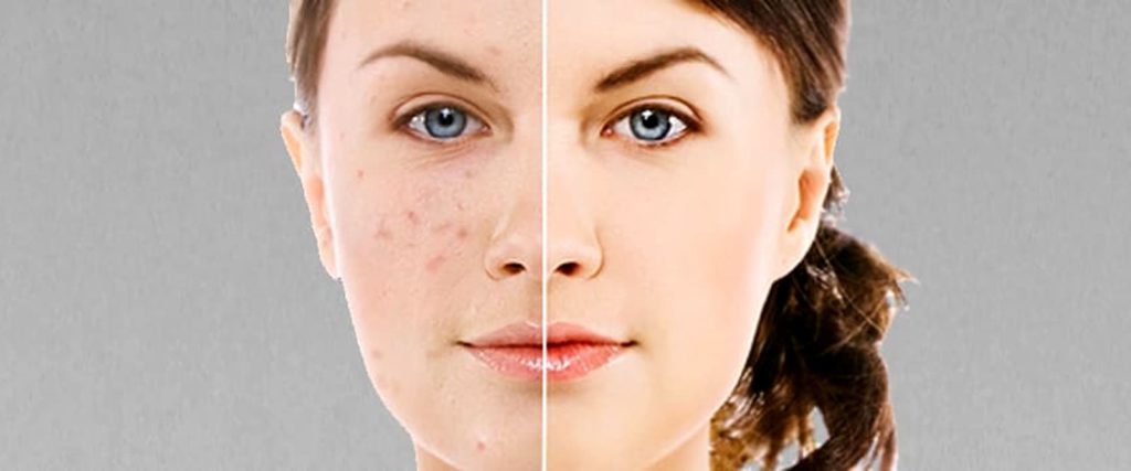 wooman face with skin acne