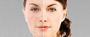 wooman face with skin acne