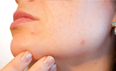 argan oil for acne face with acne spots
